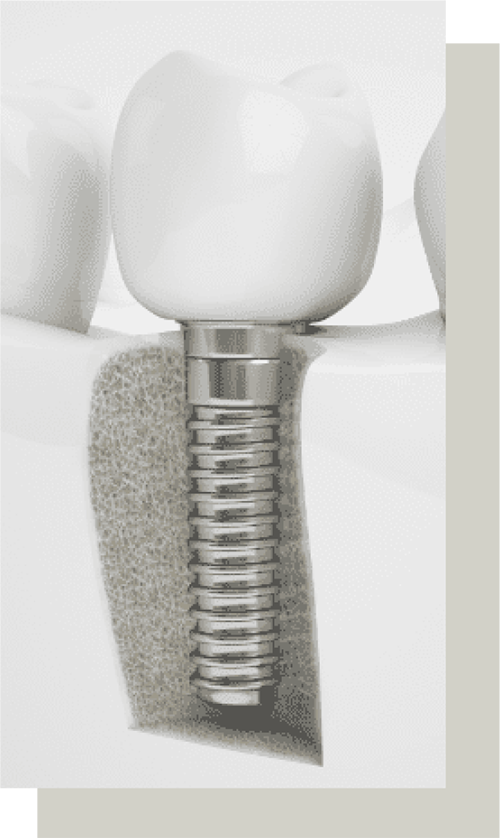 dental implants