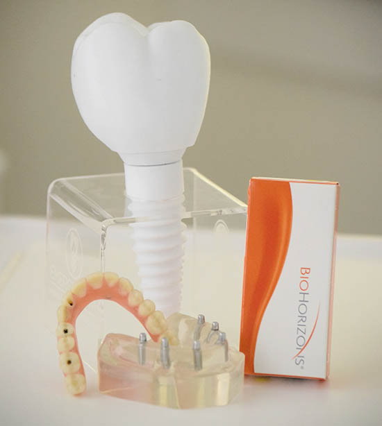 Dental Implants